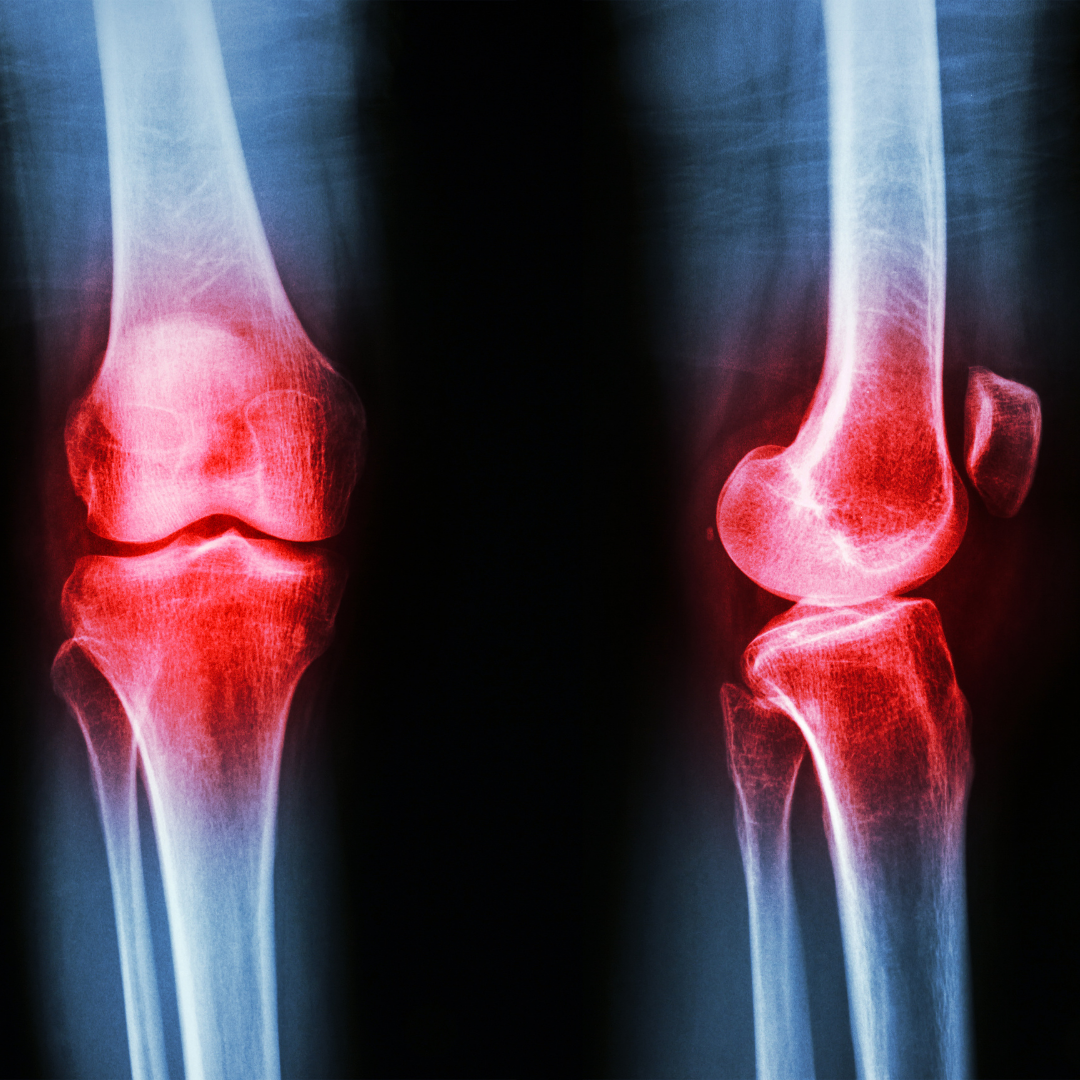 Artrosi e Osteopatia: come gestire dolore e rigidità articolare